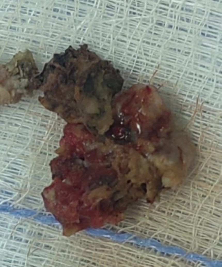 استئصال ورم دماغي ينهي معاناتها "خمسينية" من تشنجات متكررة بعنيزة