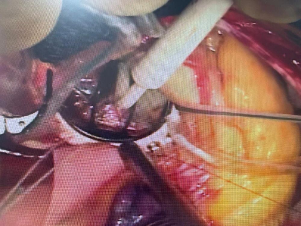 إعادة توجيه: نجاح 4 عمليات قلب مفتوح في  أسبوع بالقصيم