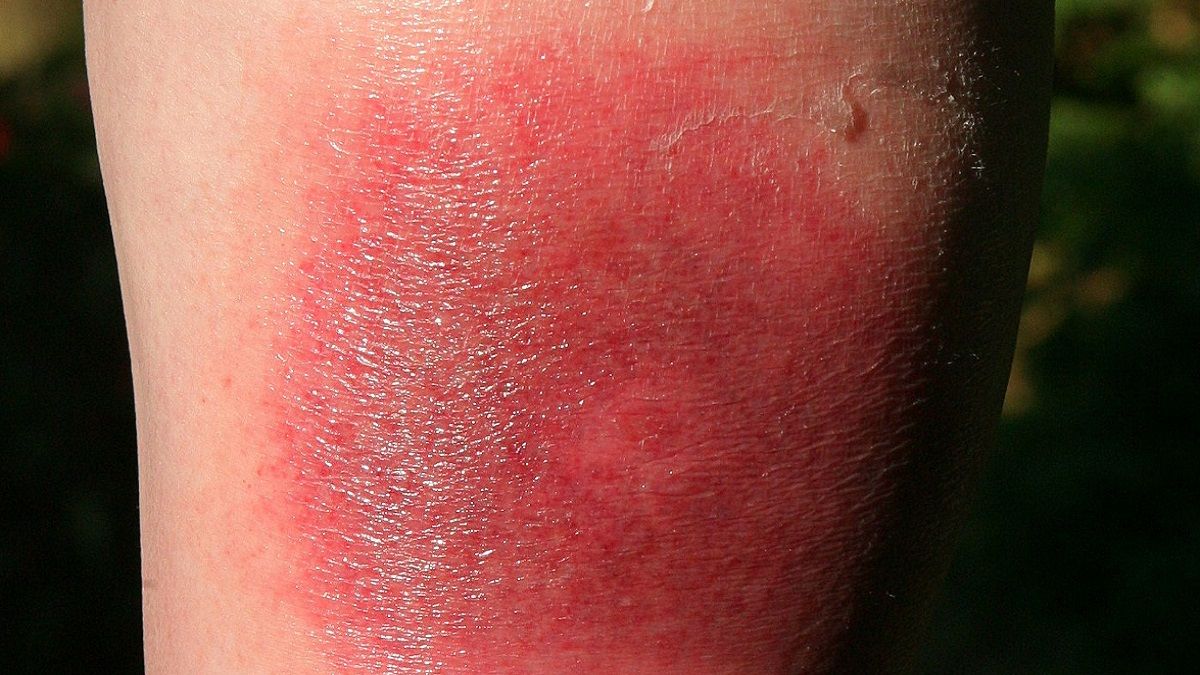 الامارات | لدغة حشرة صغيرة تنتشر في الصيف قد تتسبب بمشكلة كبيرة