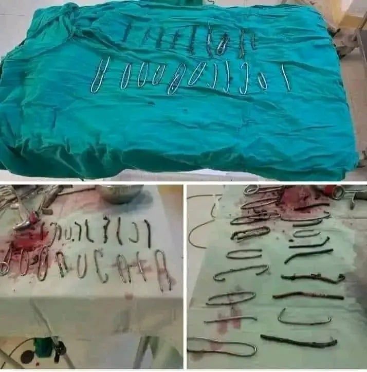 استخراج 20 مسماراً وأسلاك معدنية من بطن مريض بالجزائر