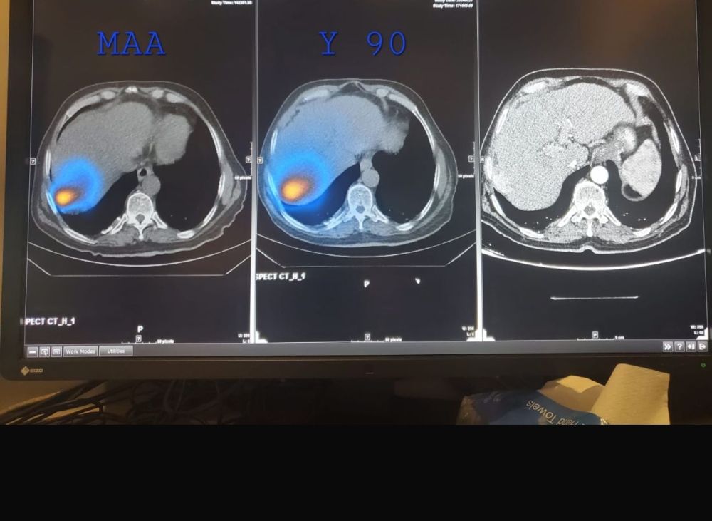 فريق بمدينة الملك فهد الطبية ينجح في علاج مريض سرطان كبد بالحبيبات المشعة