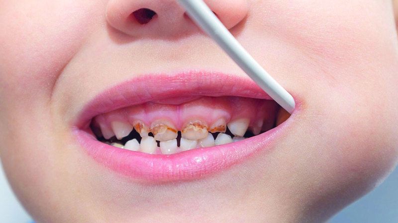 الامارات | وصفة تحمي الأسنان اللبنية من التسوس