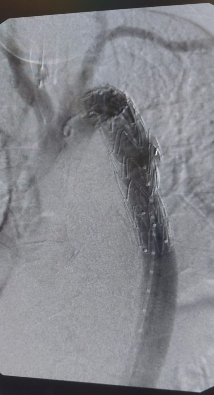 إنقاذ حياة ستيني يعاني تمدد بالشريان الأورطي الصدري في تخصصي بريدة