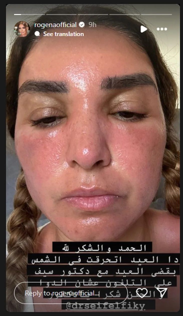 جمهورها في حالة صدمة.. إصابة روجينا بحروق مرعبة في الوجه