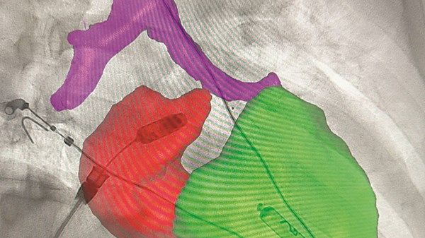 مستشفى القاسمي يزرع منظماً لاسلكياً لضربات القلب «ثنائي الحجرات»