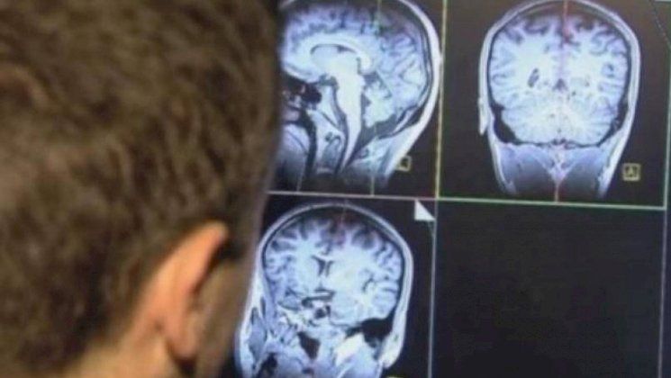 انجاز طبي عالمي.. تثبيت أول جهاز للصرع في الجمجمة