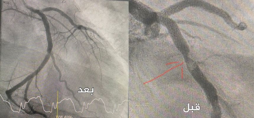 تقنية الشق الجراحي المصغّر تنهي تشوهات صمام قلب شاب بالقصيم