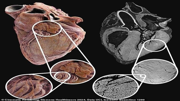 صور تكشف الفرق بين القلب المعتل والسليم