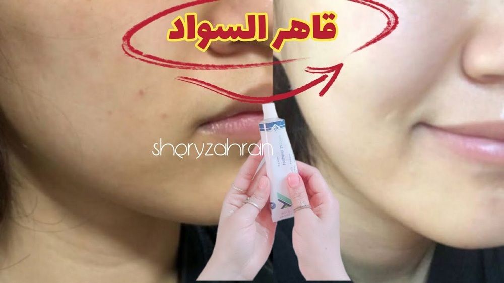 هل تعانين من بشرة سوداء داكنة؟...اليك الحل "قاهر السواد"كريم سحري يفتح البشرة والاماكن الحساسة