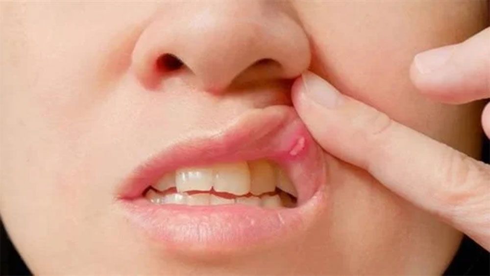 ما هي أعراض فطريات الفم وكيفية علاجها؟