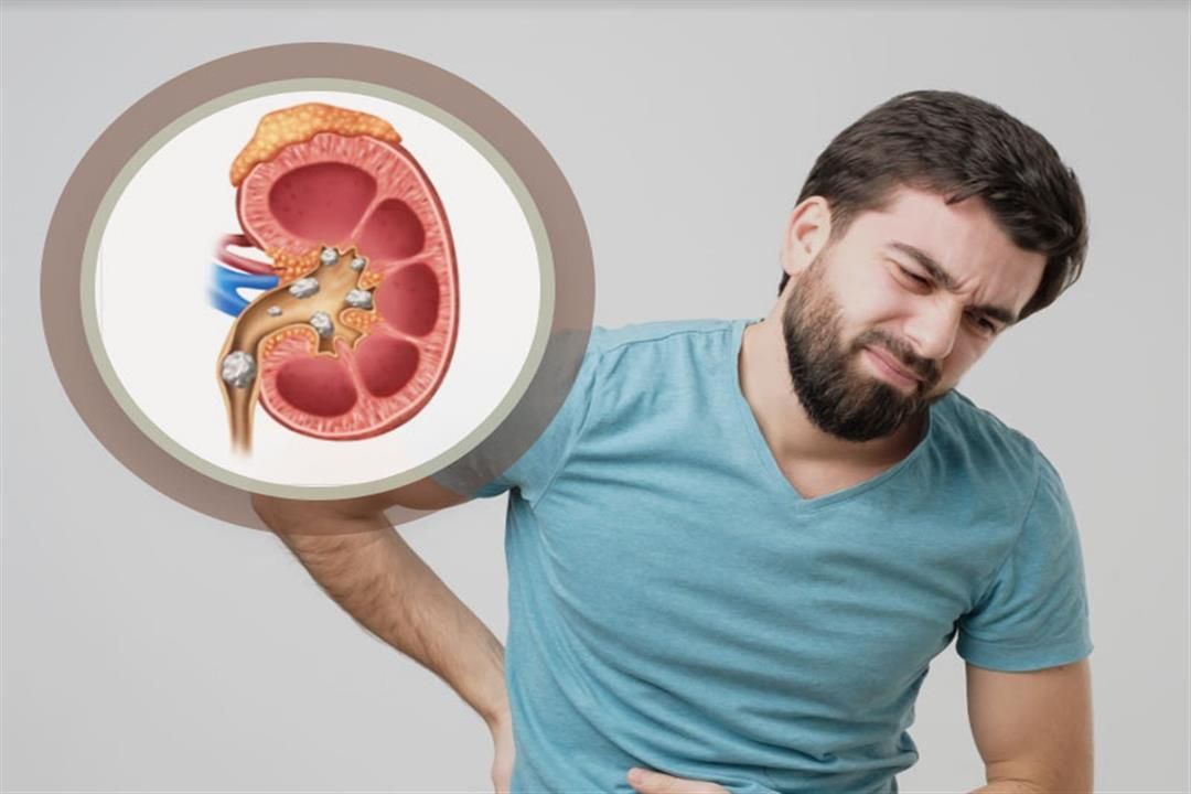 9 علامات تشير إلى خروج الحصوات من الكلى.. لا تتجاهلها