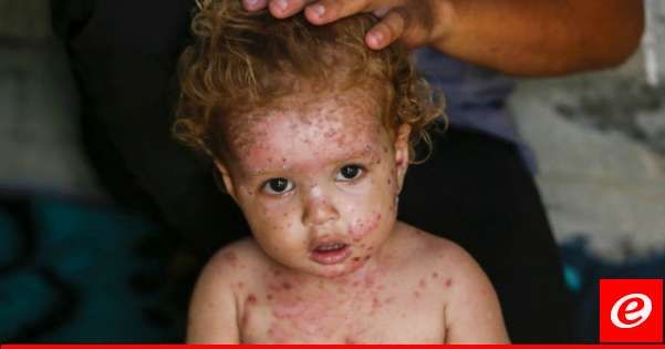 مسؤول صحي بقطاع غزة حذر من ظهور أمراض جلدية بينها التهاب جلدي حادّ