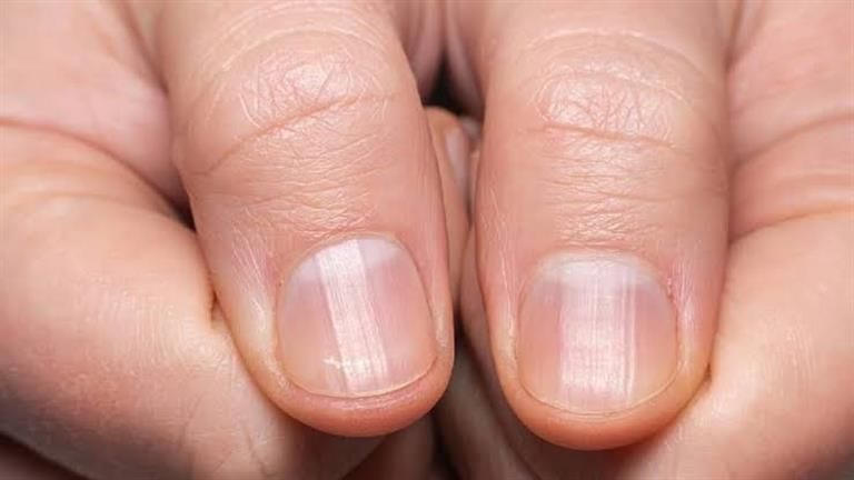 احذر هذه العلامات.. أظافرك تخبرك بكارثة عن كليتك