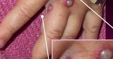 وزارة الصحة تكشف طرق انتقال مرض جدرى القرود وتؤكد: تنشيط إجراءات الترصد