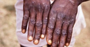 السويد ترصد أول إصابة بالسلالة الجديدة من جدري القردة خارج أفريقيا