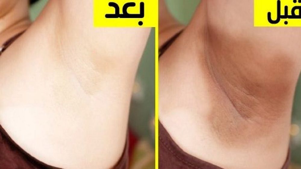 كريم طبيعي لتبييض المناطق الحساسة شديدة السواد بياض ملفت من أول استعمال!!