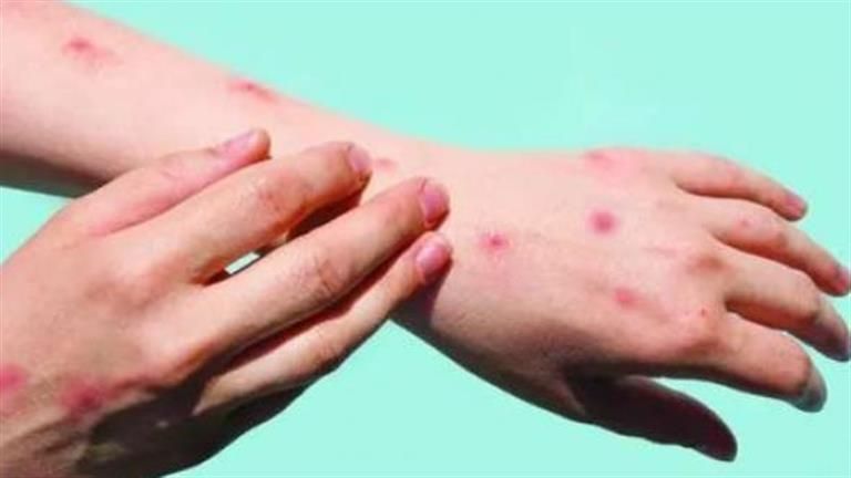 علامة تظهر على اليد تكشف إصابتك بسرطان الدم.. اذهب للطبيب فورا