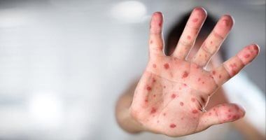 إزاي تحمي نفسك من جدري القرود.. طرق الوقاية