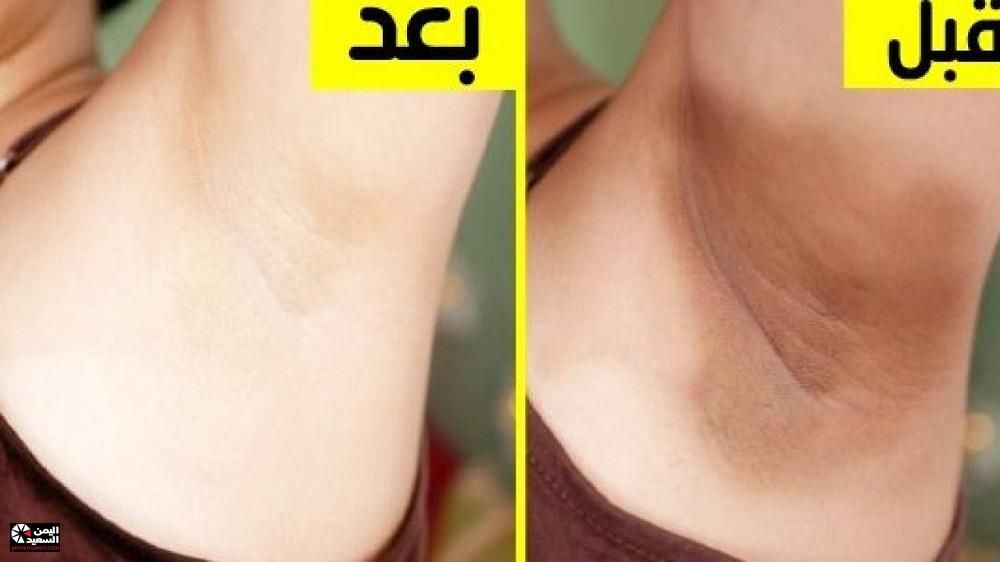 كريم طبيعي لتبييض المناطق الحساسة شديدة السواد بياض ملفت من أول استعمال!