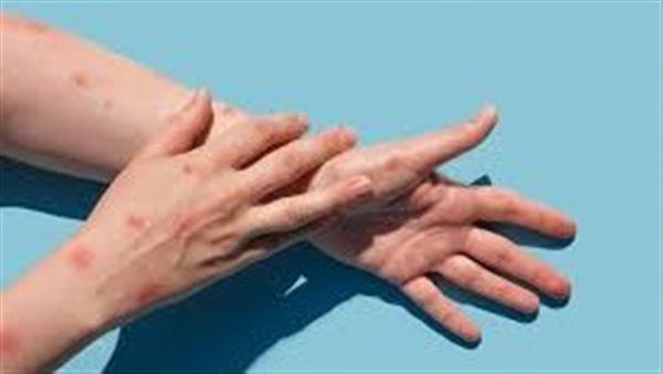 الصحة العالمية تدعو لتضامن أوروبا مع إفريقيا لتوفير عادل للقاح جدري القردة