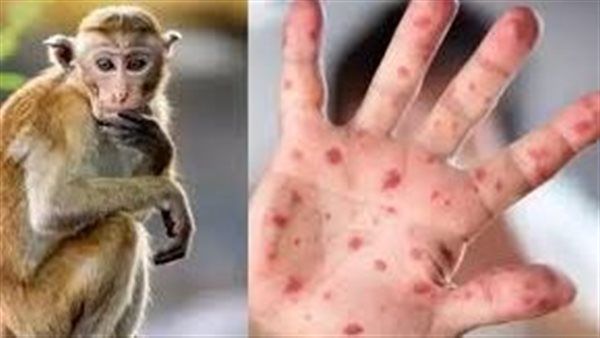 جدري القرود .. كوريا الجنوبية تعزز مراقبة القادمين من 8 دول أفريقية