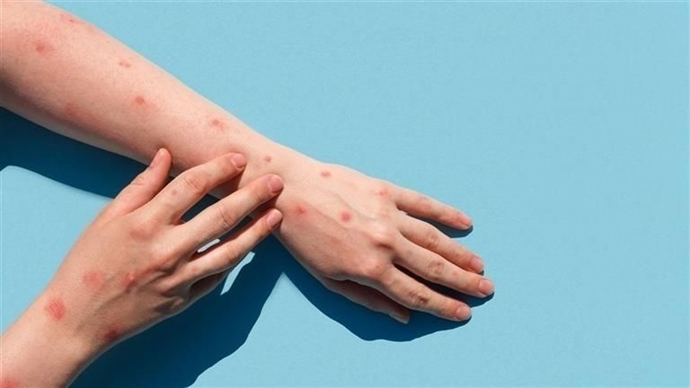 بعد تحذير الصحة العالمية.. أنواع جدري القرود - وهل تسبب الوفاة؟