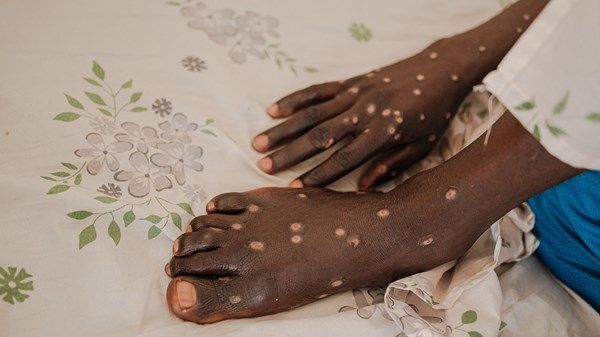 لأول مرة.. ساحل العاج ترصد حالات إصابة بجدري القردة