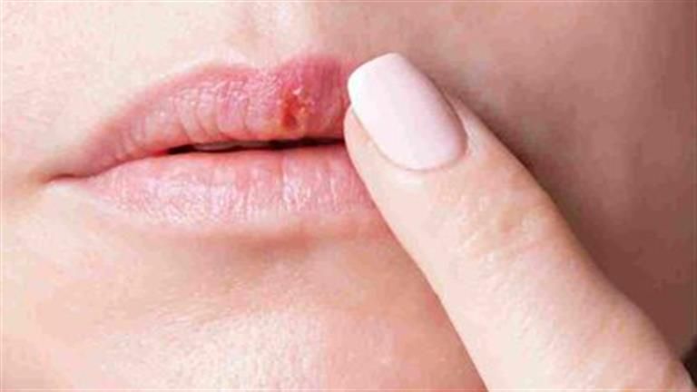 علامات خطيرة لـ سرطان الشفاه.. وكم من الوقت يستغرق انتشاره في الجسم؟