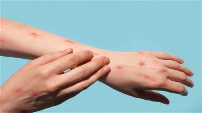 ​جدري القرود وجدري الماء.. ما الفرق بينهما وأيهما أكثر خطورة؟