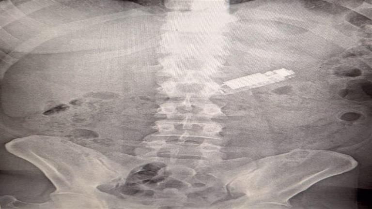 ظل 5 أشهر في معدته.. استخراج "محمول" من بطن مريض