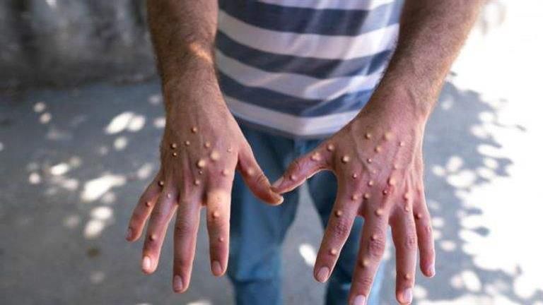 هل رصدت أسوان حالات إصابة بجدري القرود؟.. مدير الطب الوقائي يوضح