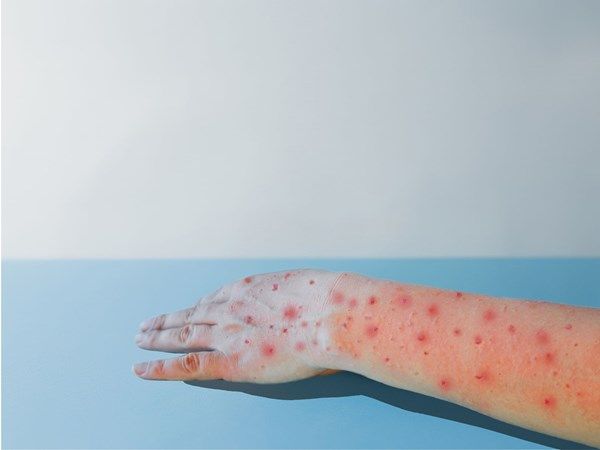 11 حالة إصابة بجدري القرود في كوريا