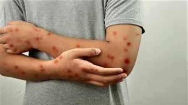 كوريا الجنوبية تسجل 11 حالة إصابة بفيروس جدري القردة