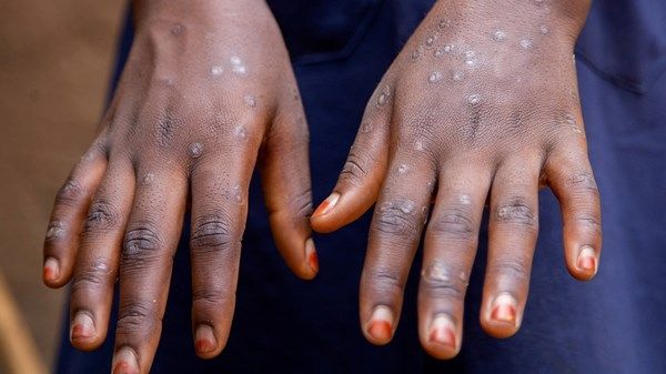 كينيا تسجل أول إصابة بجدري القردة في العاصمة