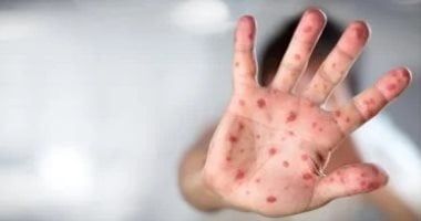 وزارة الصحة الأردنية تسجل إصابة بجدرى القرود لشخص غير أردنى مقيم فى البلاد