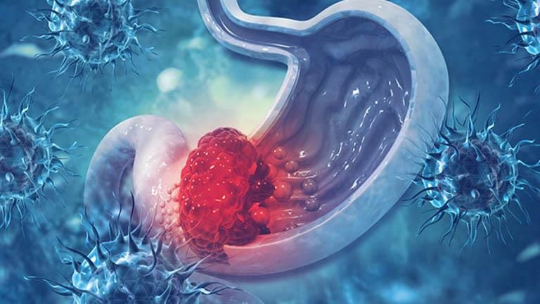 لا تتجاهلها.. 4 علامات خفية تشير إلى سرطان المعدة