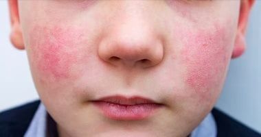 ما تستهونش بيه.. فيروس بارفو أو ما يطلق عليه الخد المصفوع يسبب الإجهاض