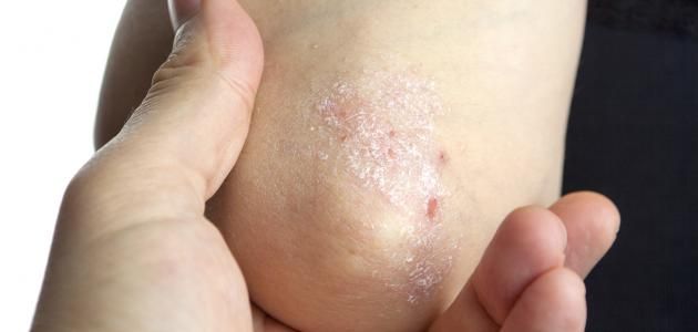 الامارات | كيفية التمييز بين بعض الأمراض الجلدية