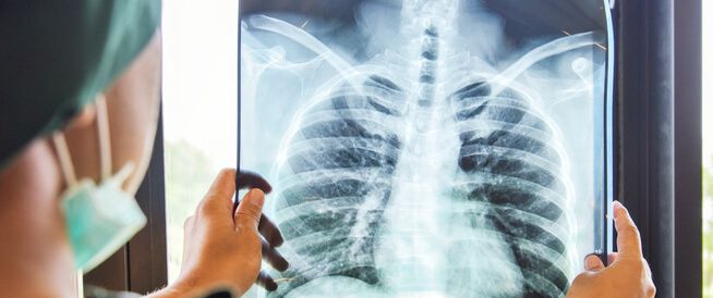 منظمة الصحة العالمية: السل يتجاوز “كوفيد – 19” كأكبر الأمراض المعدية القاتلة