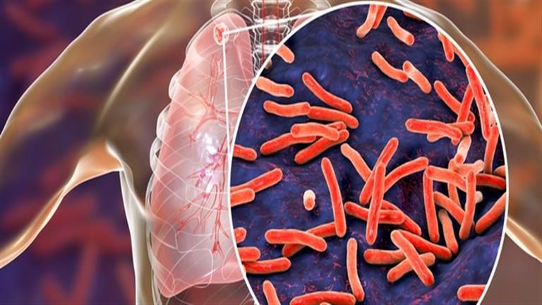 الصحة العالمية تحذر من تفشي مرض شديد العدوى