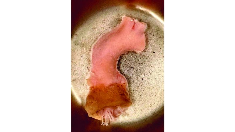 الامارات | نجاح جراحة معقدة لاستبدال صمام أبهري لطفلة في مستشفى القاسمي