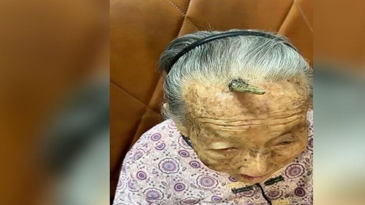 الامارات | "قرن طول العمر" ينمو من جبهة عجوز صينية