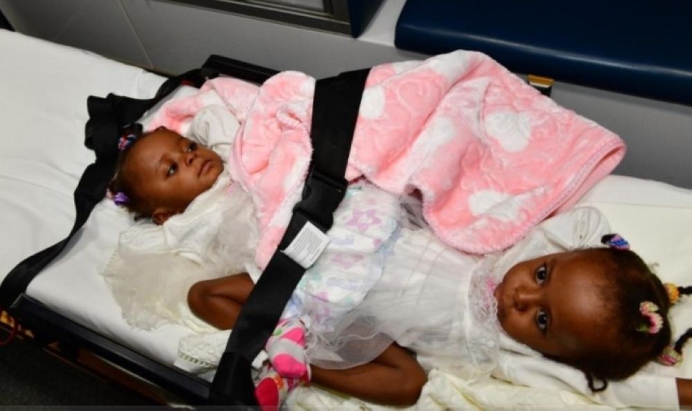 ريادة عالمية.. "اليوم" ترصد بالأرقام إنجازات المملكة في فصل التوائم السيامية