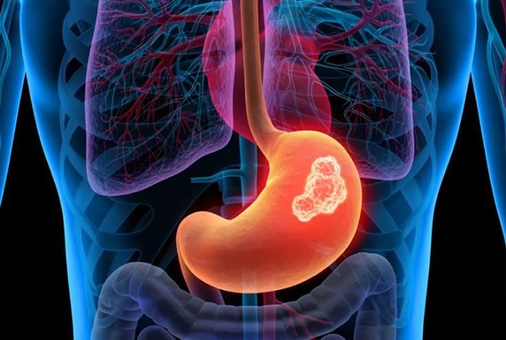 الامارات | لمن تقل أعمارهم عن 50 عامًا.. تحذير من ارتفاع معدلات السرطان الهضمي