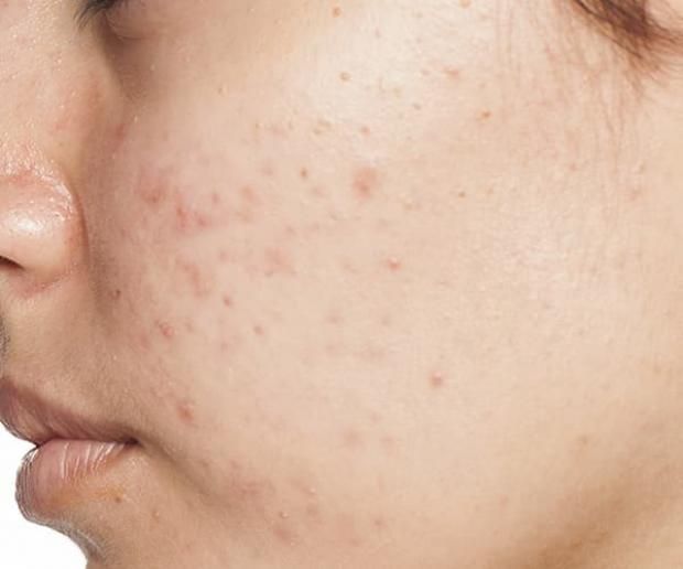 كيف تتخلصين من البثور الجلدية في خطوات بسيطة؟.. تجنبي هذا الفعل