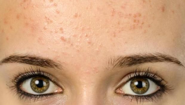 كيف تتخلصين من البثور الجلدية في خطوات بسيطة؟.. تجنبي هذا الفعل