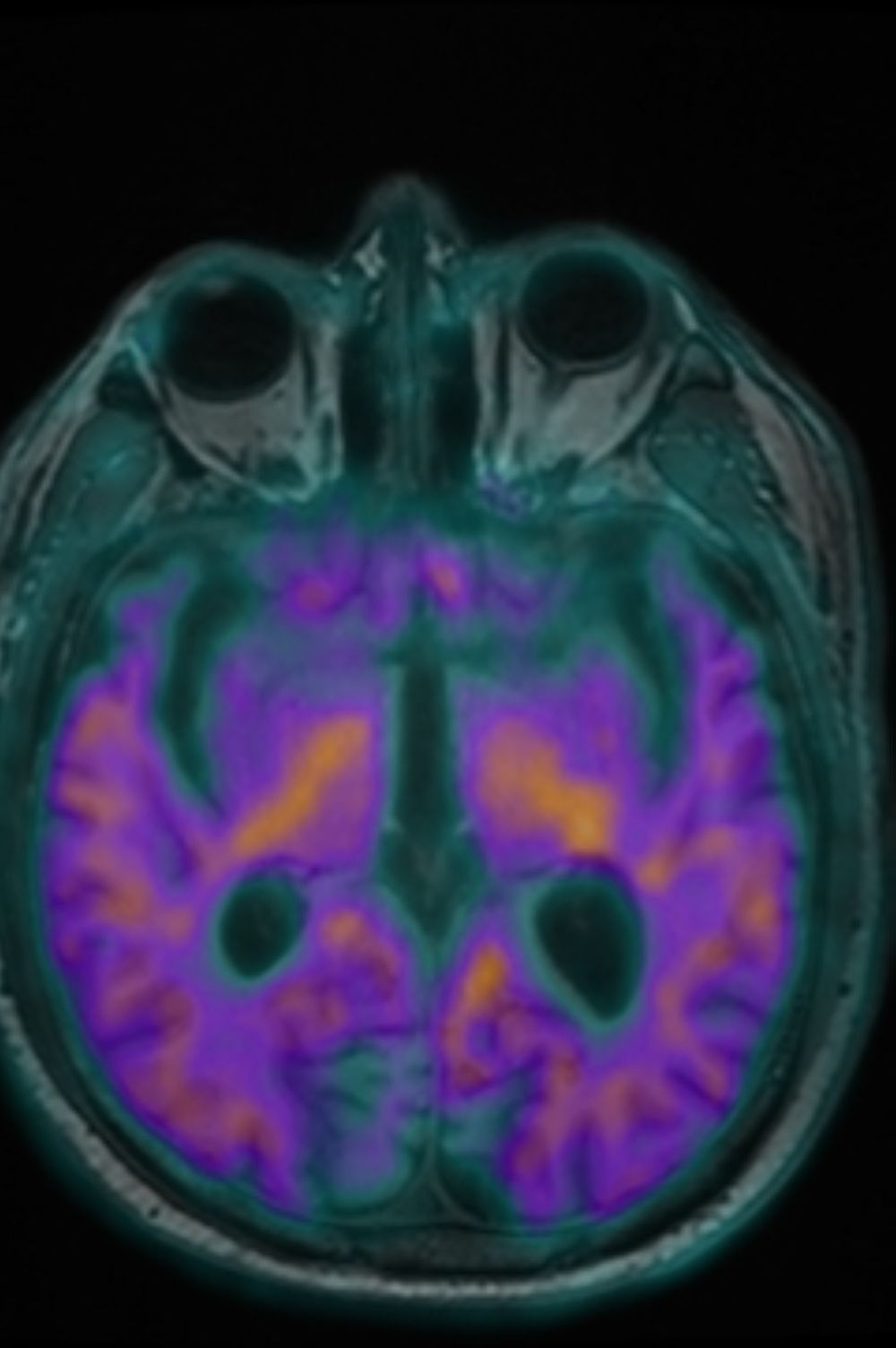 تدشين تقنية جديدة لتشخيص الزهايمر لأول مرة في الشرق الأوسط