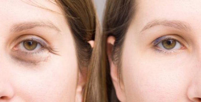 تخلصي من تجاعيد العينين بـ4 خلطات طبيعية.. خطوات سهلة لتحضيرها