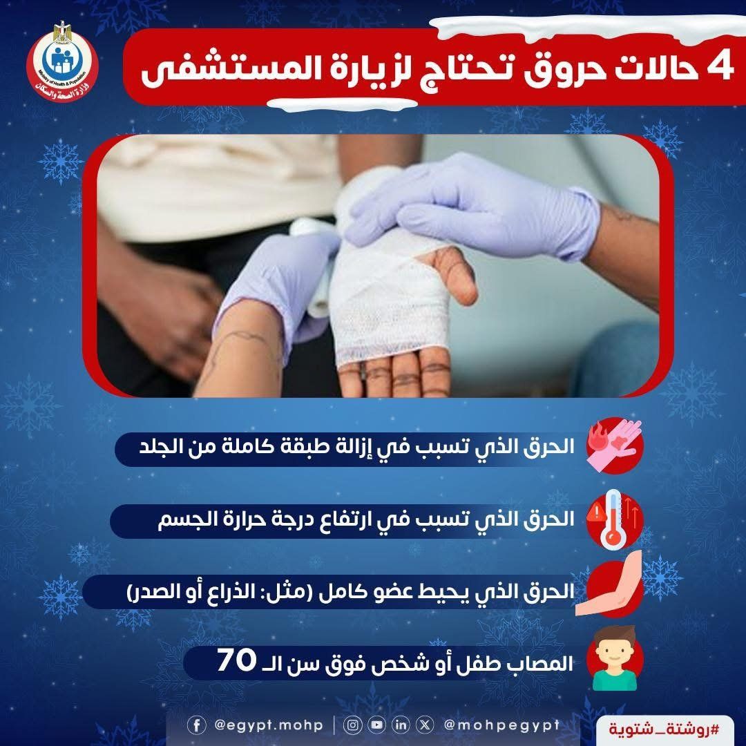 وزارة الصحة تكشف عن 4 حالات حروق تحتاج لزيارة المستشفى