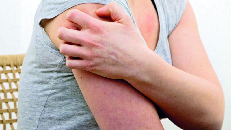 الامارات | متاعب حساسية النيكل تتخطى الجلد أحياناً